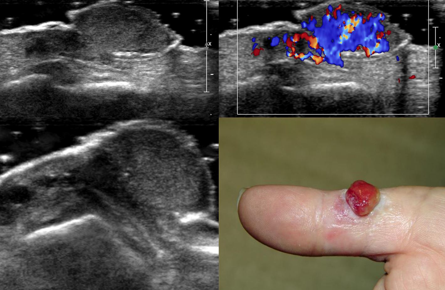 Figure 2 for case Pyogenic Granuloma